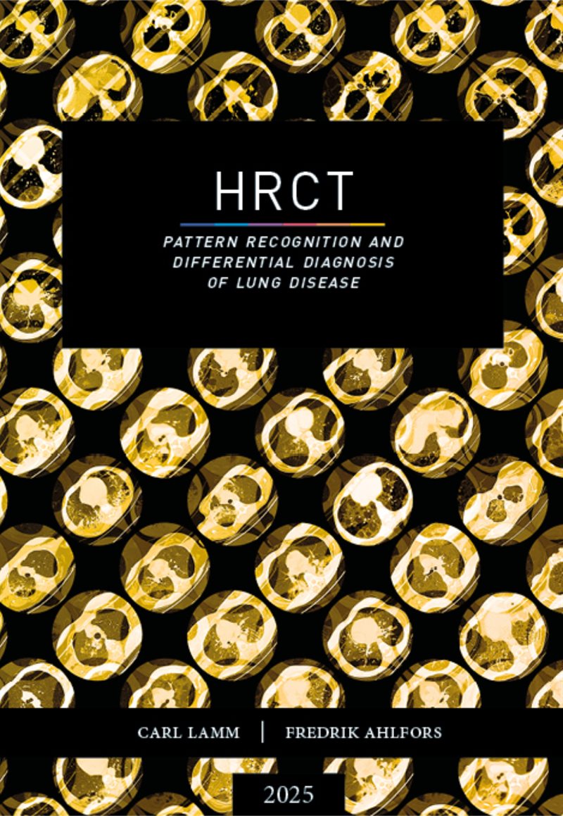 HRCT : pattern recognition and differential diagnosis of lung disease